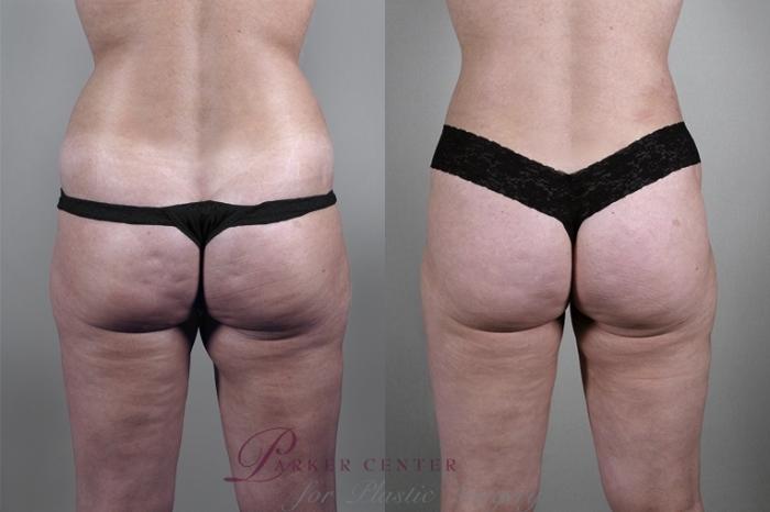 Liposuction Case 926 Before & After View #5 | Paramus, NJ | Parker Center for Plastic Surgery