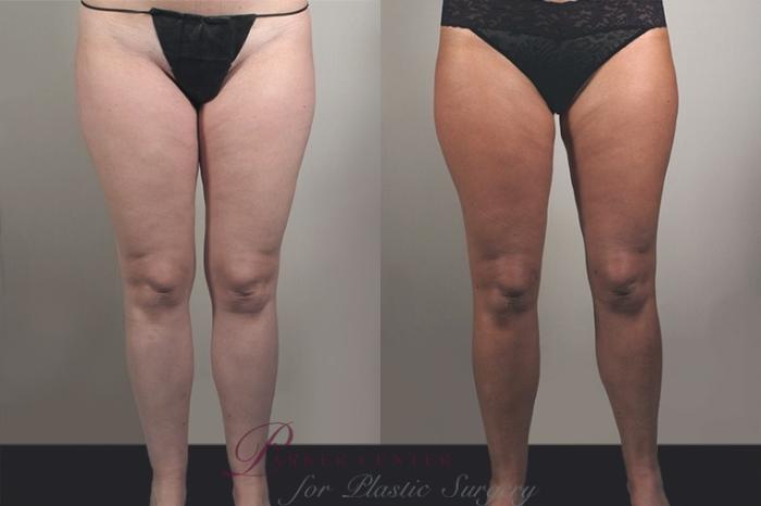 Liposuction Case 927 Before & After View #5 | Paramus, NJ | Parker Center for Plastic Surgery
