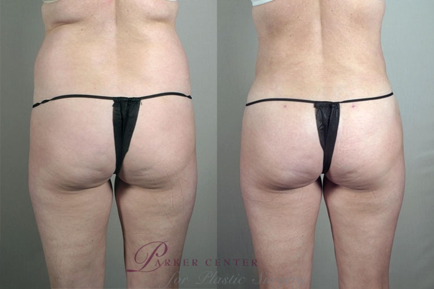 Liposuction Case 936 Before & After View #5 | Paramus, NJ | Parker Center for Plastic Surgery