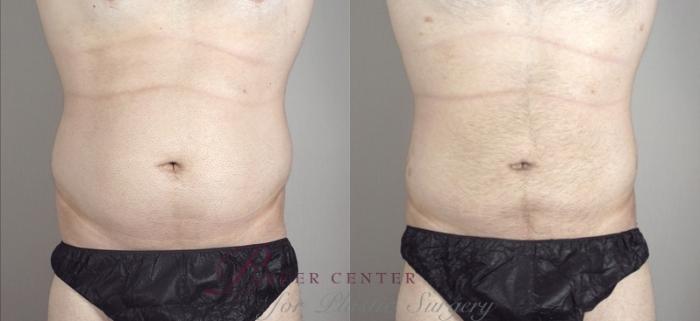 Liposuction Case 948 Before & After View #5 | Paramus, NJ | Parker Center for Plastic Surgery