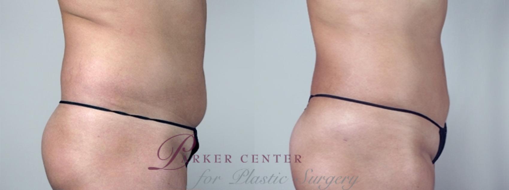 Liposuction Case 962 Before & After View #5 | Paramus, NJ | Parker Center for Plastic Surgery