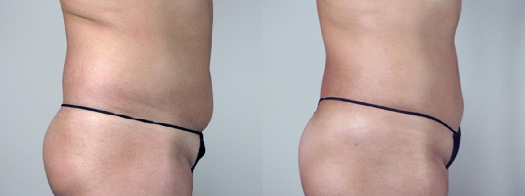 Liposuction Case 962 Before & After View #5 | Paramus, NJ | Parker Center for Plastic Surgery