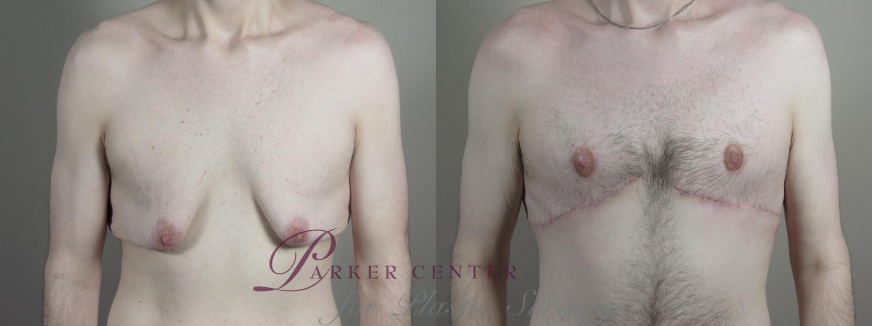 Male Breast Reduction Case 1010 Before & After Front | Paramus, NJ | Parker Center for Plastic Surgery