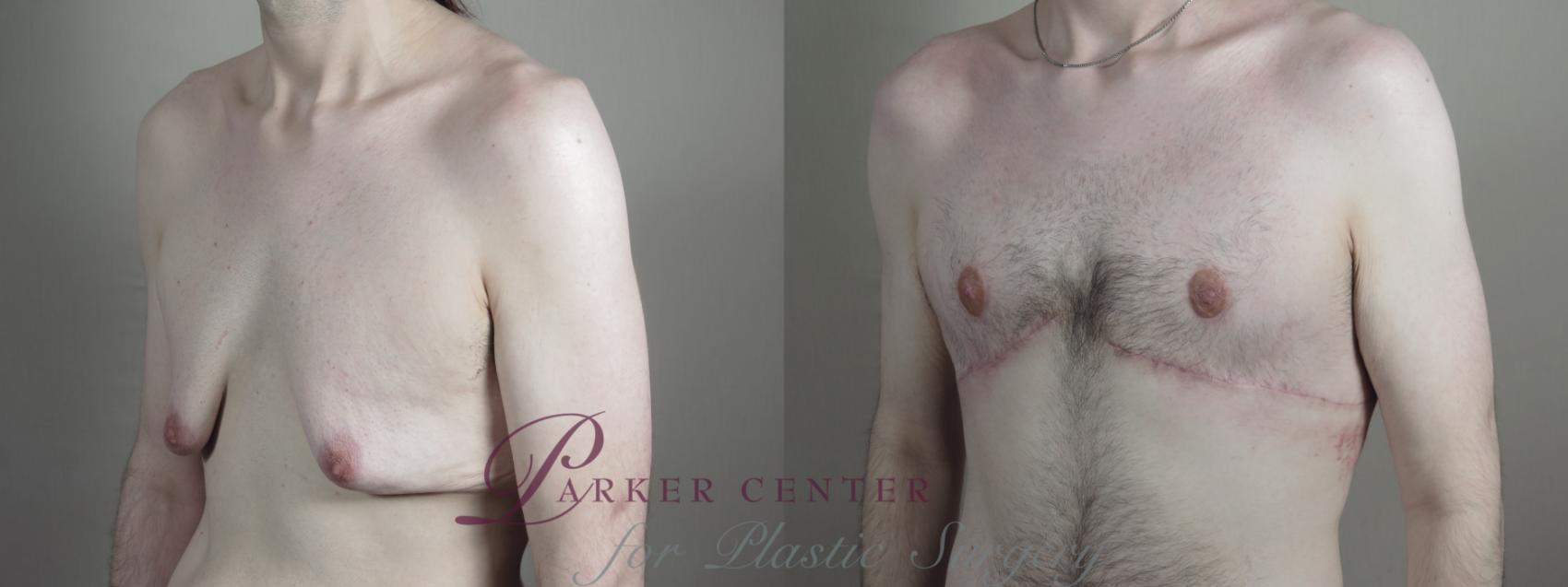 Male Breast Reduction Case 1010 Before & After Right Oblique | Paramus, NJ | Parker Center for Plastic Surgery
