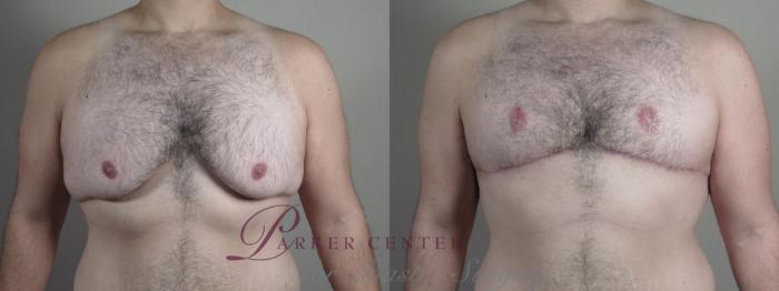 Male Breast Reduction Case 1094 Before & After Front | Paramus, NJ | Parker Center for Plastic Surgery