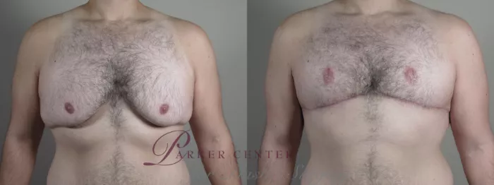 Breast Augmentation Before & After Photos Patient 1094