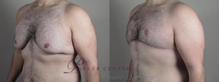 Male Breast Reduction Case 1094 Before & After Right Oblique | Paramus, NJ | Parker Center for Plastic Surgery