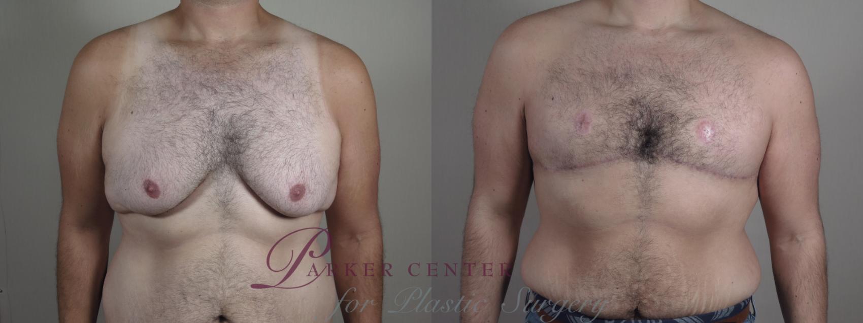 Male Breast Reduction Case 1206 Before & After View #1  | Paramus, NJ | Parker Center for Plastic Surgery