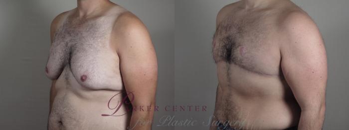 Male Breast Reduction Case 1206 Before & After View #2 | Paramus, NJ | Parker Center for Plastic Surgery