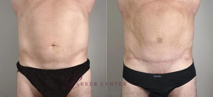 Male Breast Reduction Case 1295 Before & After front  | Paramus, NJ | Parker Center for Plastic Surgery