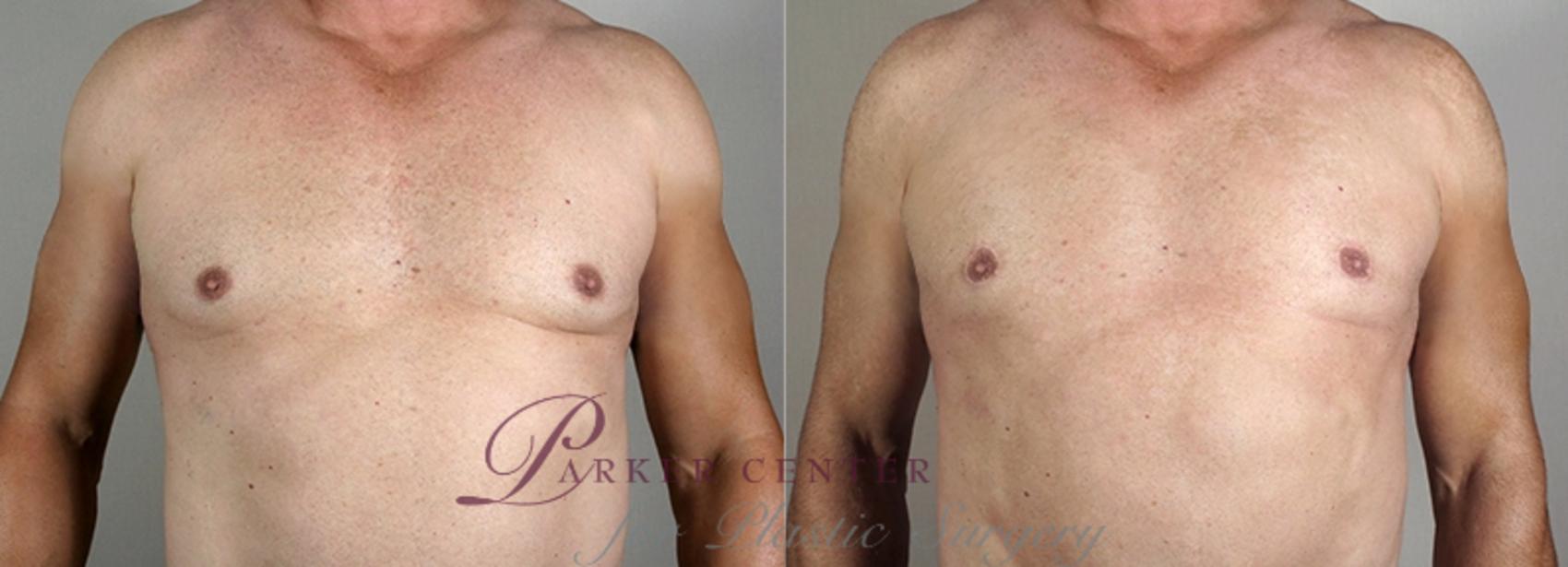 Male Breast Reduction Case 1295 Before & After Front | Paramus, New Jersey | Parker Center for Plastic Surgery
