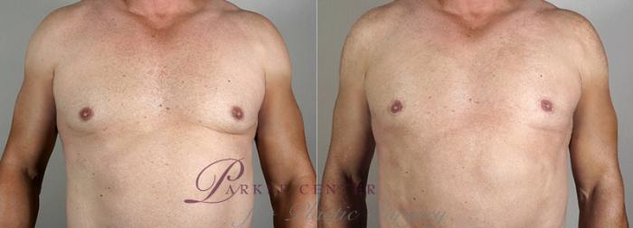Male Breast Reduction Case 1295 Before & After Front | Paramus, NJ | Parker Center for Plastic Surgery