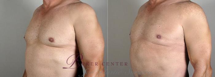 Male Breast Reduction Case 1295 Before & After Left Oblique | Paramus, NJ | Parker Center for Plastic Surgery