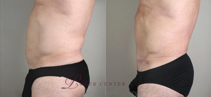 Male Breast Reduction Case 1295 Before & After Left Side | Paramus, NJ | Parker Center for Plastic Surgery