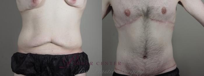 Male Breast Reduction Case 1336 Before & After Front | Paramus, NJ | Parker Center for Plastic Surgery