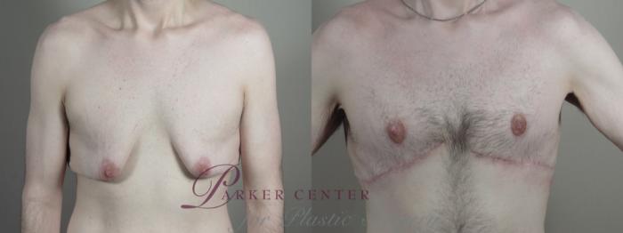 Male Breast Reduction Case 1336 Before & After front view 2 | Paramus, NJ | Parker Center for Plastic Surgery