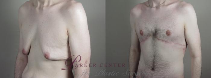 Male Breast Reduction Case 1336 Before & After Left Oblique | Paramus, NJ | Parker Center for Plastic Surgery