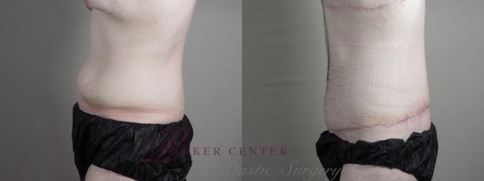 Male Breast Reduction Case 1336 Before & After Left Side | Paramus, NJ | Parker Center for Plastic Surgery