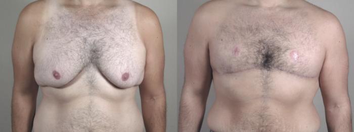 Male Breast Reduction Case 1506 Before & After Front | Paramus, New Jersey | Parker Center for Plastic Surgery