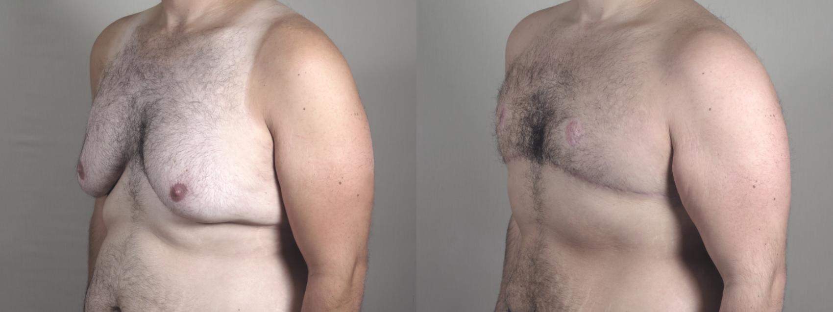 Male Breast Reduction Case 1506 Before & After Left Oblique | Paramus, New Jersey | Parker Center for Plastic Surgery