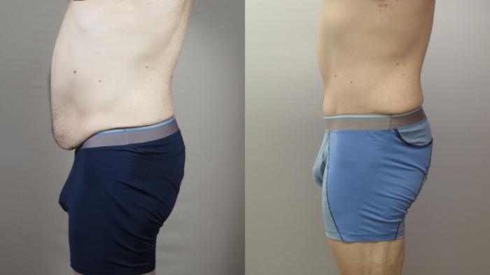 Male Breast Reduction Case 1570 Before & After left side | Paramus, New Jersey | Parker Center for Plastic Surgery