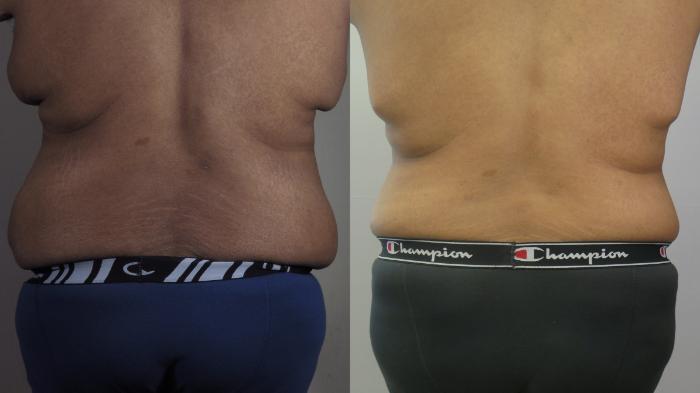 Male Breast Reduction Case 1592 Before & After Back | Paramus, New Jersey | Parker Center for Plastic Surgery