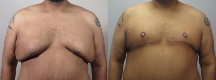 Male Breast Reduction Case 1592 Before & After Front | Paramus, New Jersey | Parker Center for Plastic Surgery