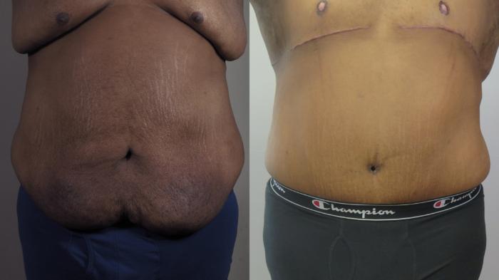 Male Breast Reduction Case 1592 Before & After front tt | Paramus, New Jersey | Parker Center for Plastic Surgery
