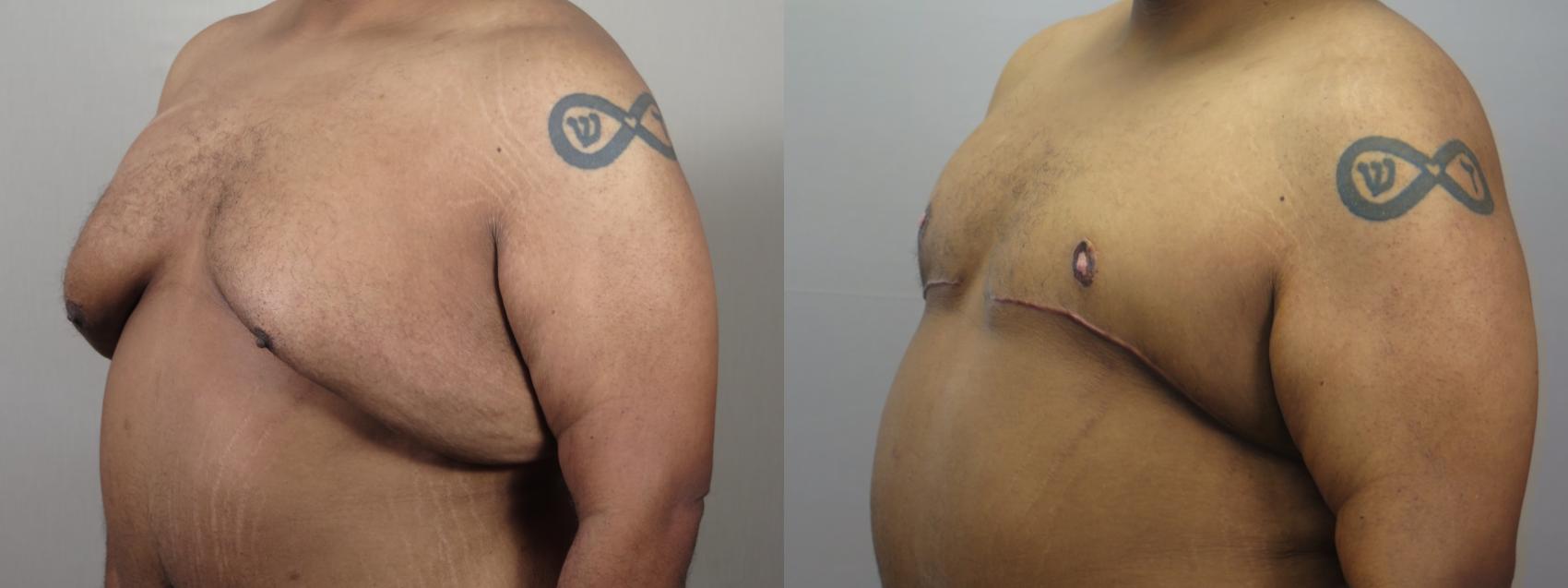 Male Breast Reduction Case 1592 Before & After Left Oblique | Paramus, New Jersey | Parker Center for Plastic Surgery