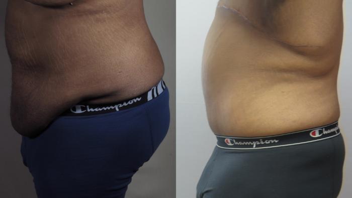 Male Breast Reduction Case 1592 Before & After Left Side | Paramus, New Jersey | Parker Center for Plastic Surgery