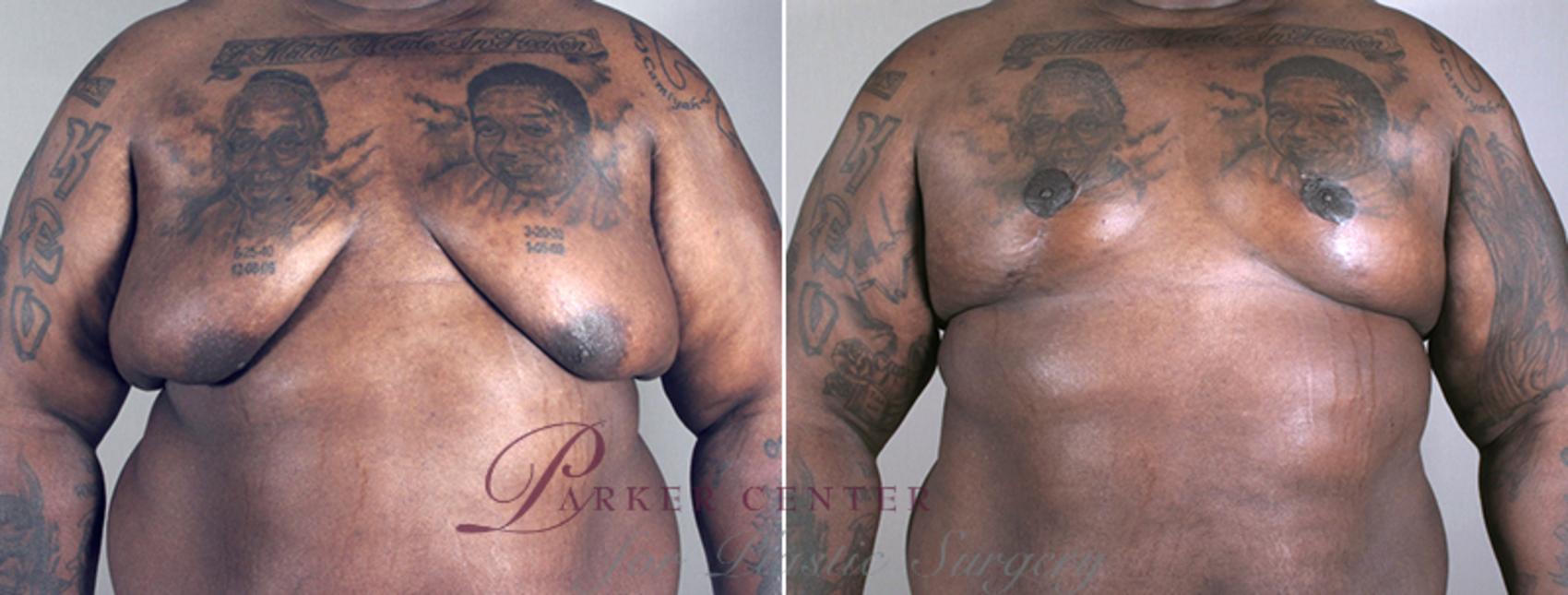 Male Breast Reduction Case 629 Before & After View #1 | Paramus, NJ | Parker Center for Plastic Surgery