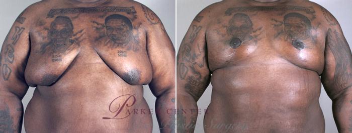 Breast Reduction Before & After Photos of Age 31 Male