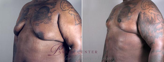 Male Breast Reduction Case 629 Before & After View #2 | Paramus, NJ | Parker Center for Plastic Surgery