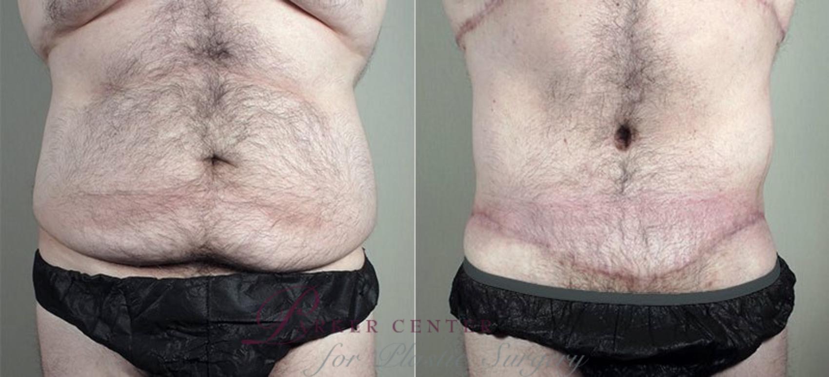 Abdominoplasty Case 673 Before & After View #2 | Paramus, NJ | Parker Center for Plastic Surgery