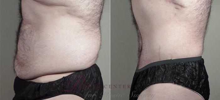 Abdominoplasty Case 673 Before & After View #3 | Paramus, NJ | Parker Center for Plastic Surgery