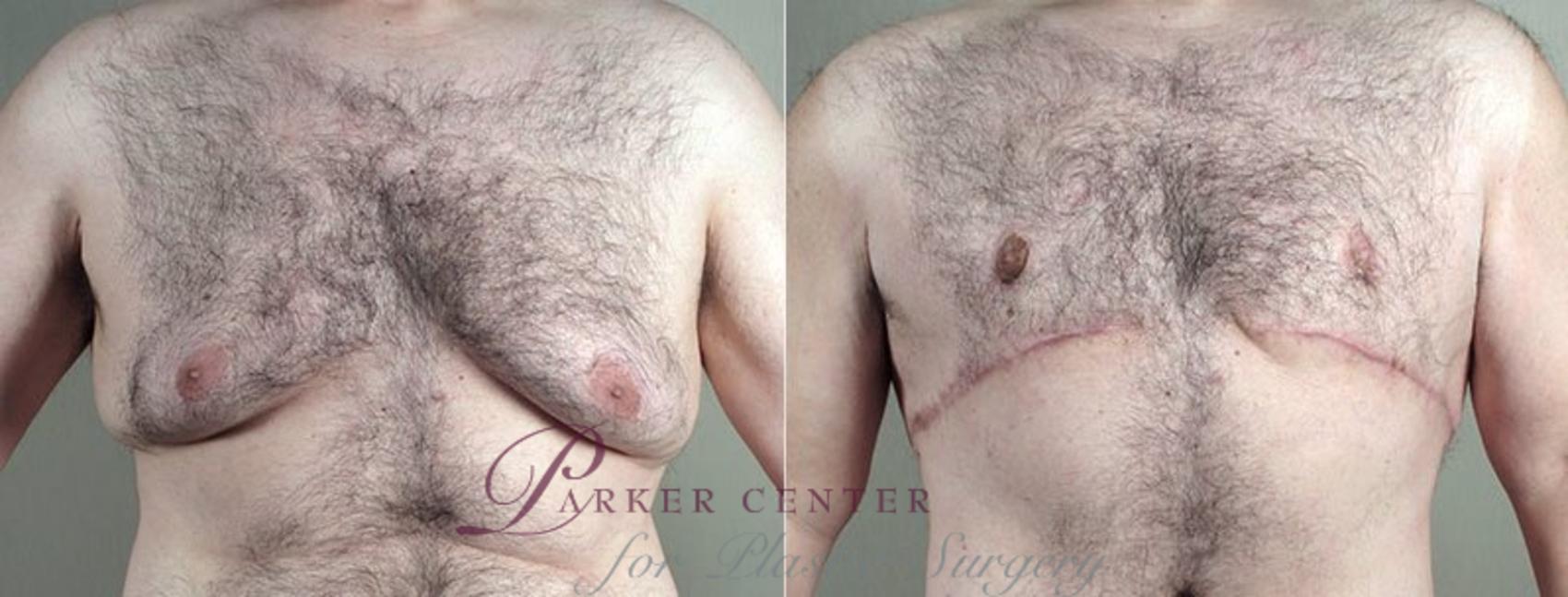 Male Breast Reduction Case 673 Before & After View #5 | Paramus, NJ | Parker Center for Plastic Surgery