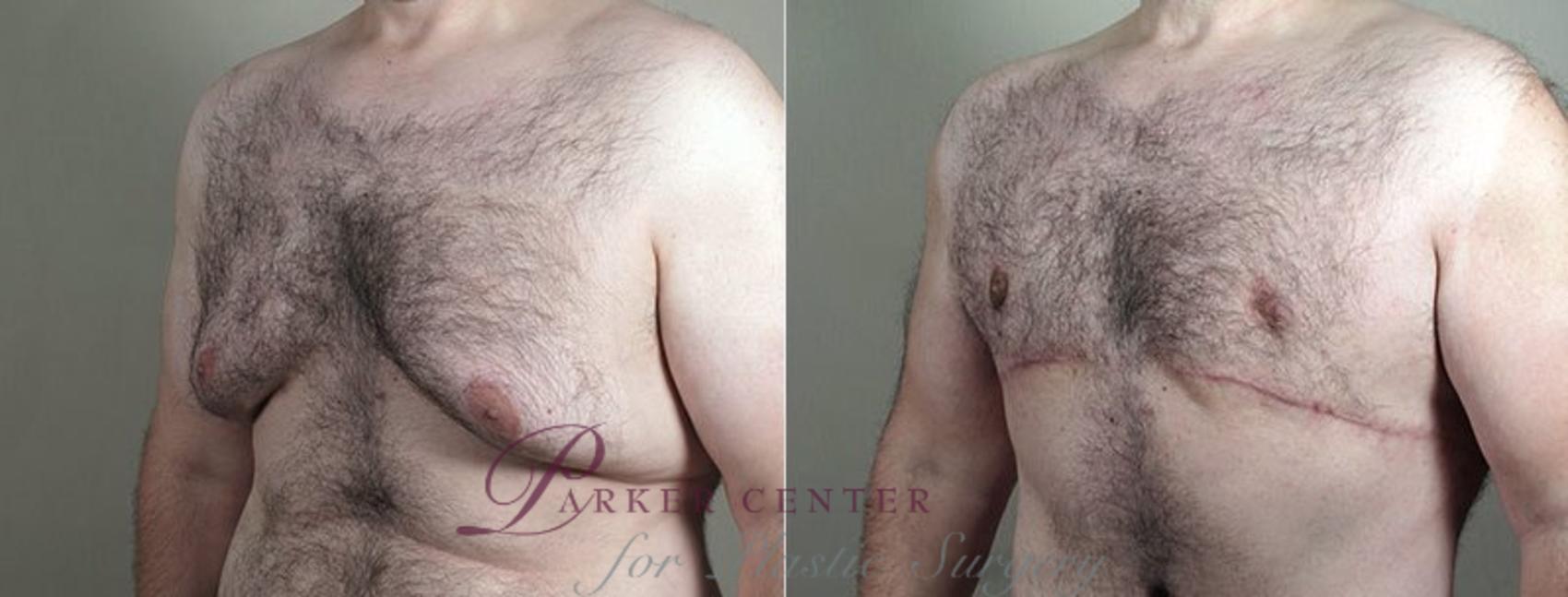 Male Breast Reduction Case 673 Before & After View #6 | Paramus, NJ | Parker Center for Plastic Surgery