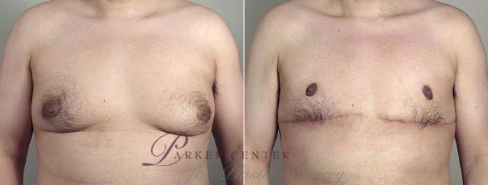 Male Breast Reduction Case 675 Before & After View #1 | Paramus, NJ | Parker Center for Plastic Surgery
