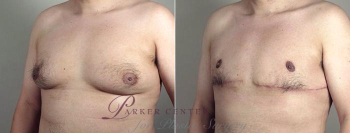 Male Breast Reduction Case 675 Before & After View #2 | Paramus, NJ | Parker Center for Plastic Surgery