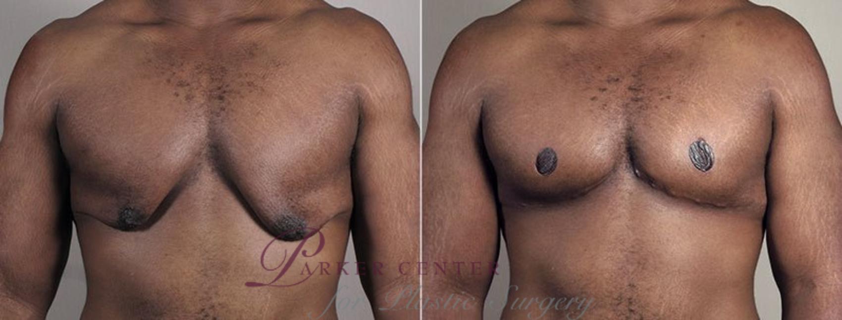 Male Breast Reduction Case 676 Before & After View #1 | Paramus, NJ | Parker Center for Plastic Surgery