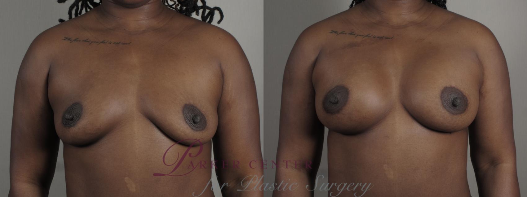 Liposuction Case 1005 Before & After Front breast | Paramus, NJ | Parker Center for Plastic Surgery