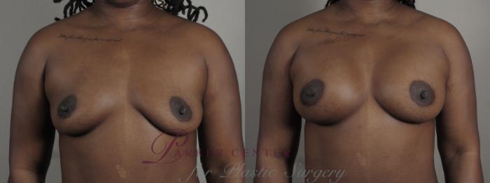 Mommy Makeover Case 1005 Before & After Front breast | Paramus, NJ | Parker Center for Plastic Surgery