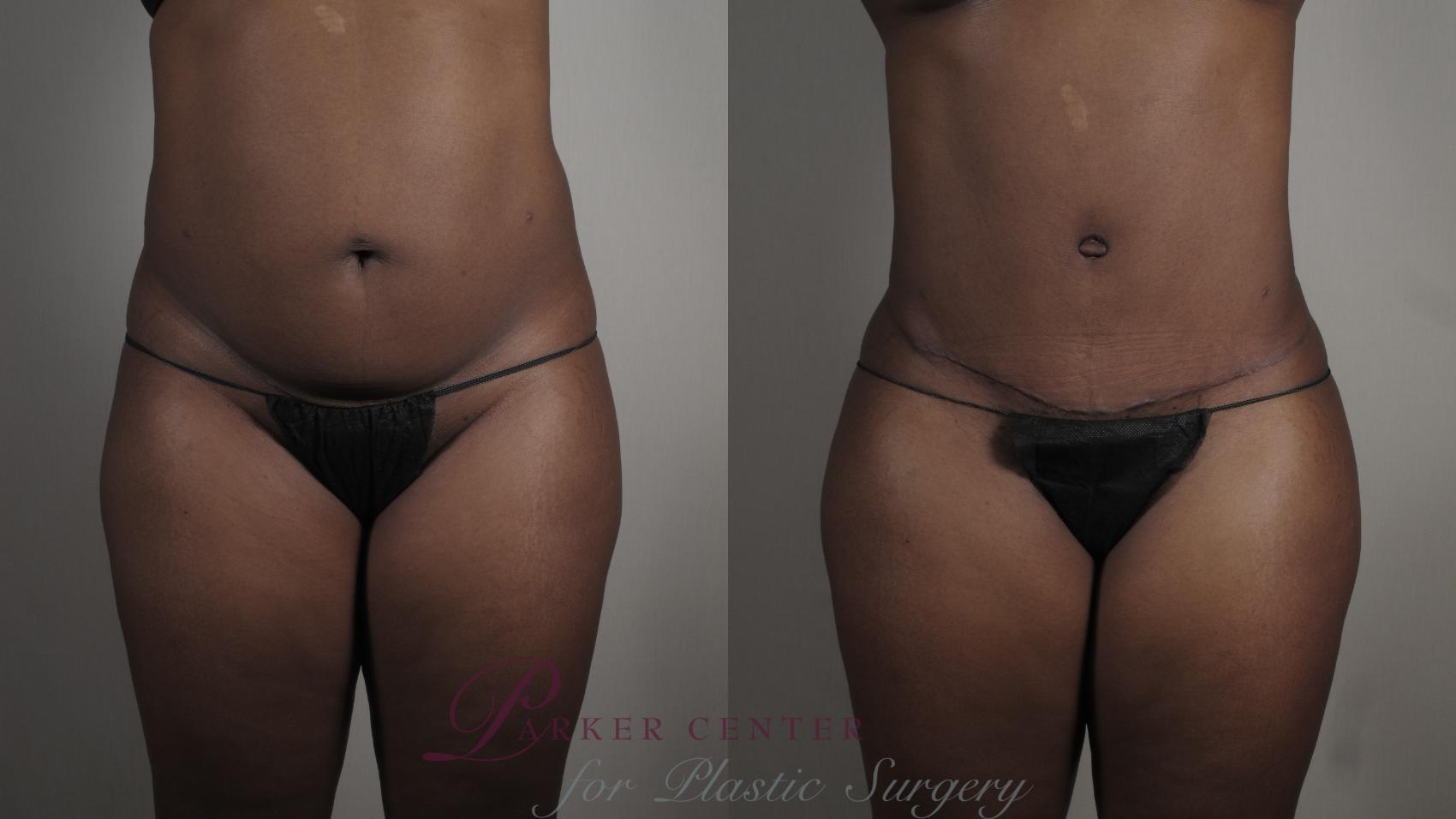 Liposuction Case 1005 Before & After Front | Paramus, NJ | Parker Center for Plastic Surgery