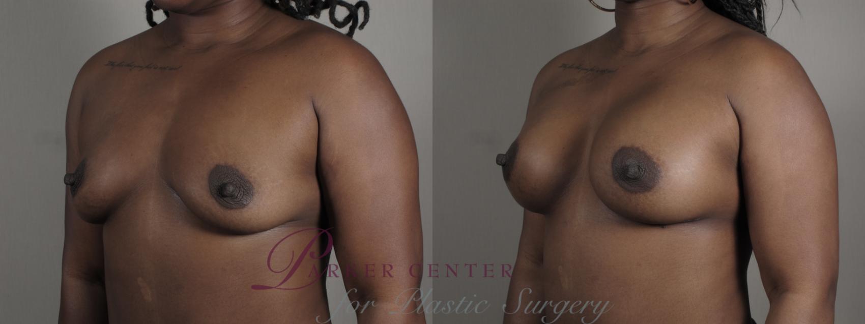 Liposuction Case 1005 Before & After Right Oblique | Paramus, NJ | Parker Center for Plastic Surgery