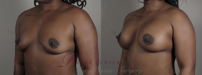 Mommy Makeover Case 1005 Before & After Right Oblique | Paramus, NJ | Parker Center for Plastic Surgery
