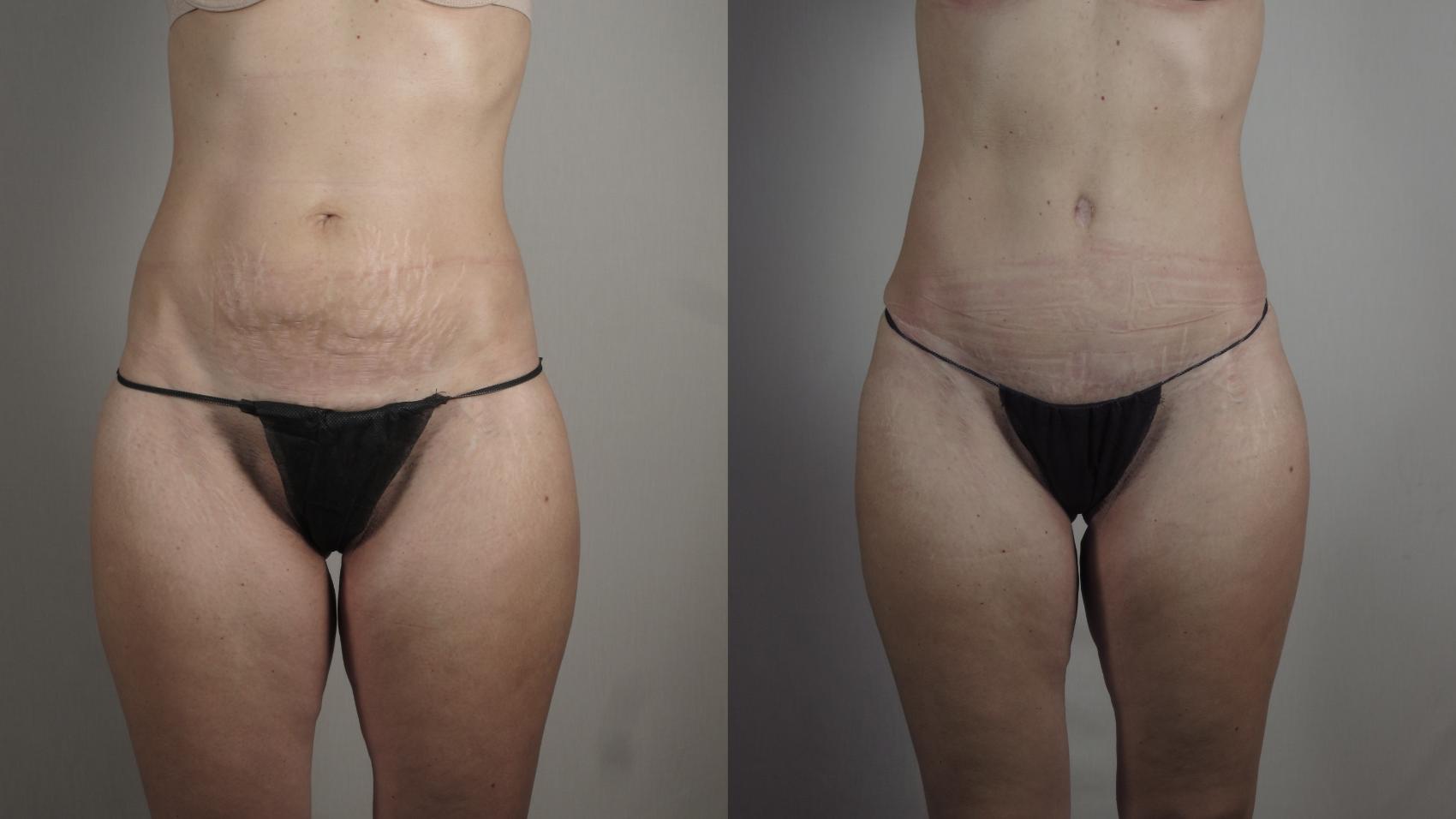 Mommy Makeover Case 1031 Before & After Front Body  | Paramus, New Jersey | Parker Center for Plastic Surgery