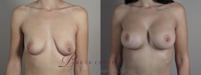 Mommy Makeover Case 1031 Before & After Front | Paramus, NJ | Parker Center for Plastic Surgery