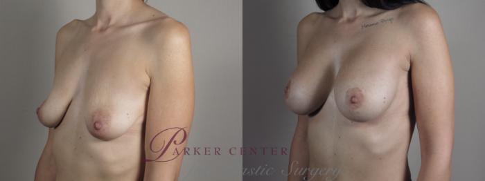 Mommy Makeover Case 1031 Before & After Right Oblique | Paramus, NJ | Parker Center for Plastic Surgery