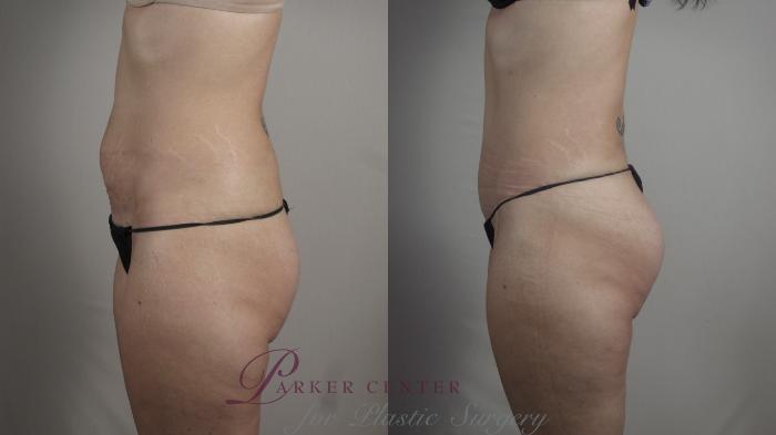 Mommy Makeover Case 1031 Before & After Right Side | Paramus, NJ | Parker Center for Plastic Surgery