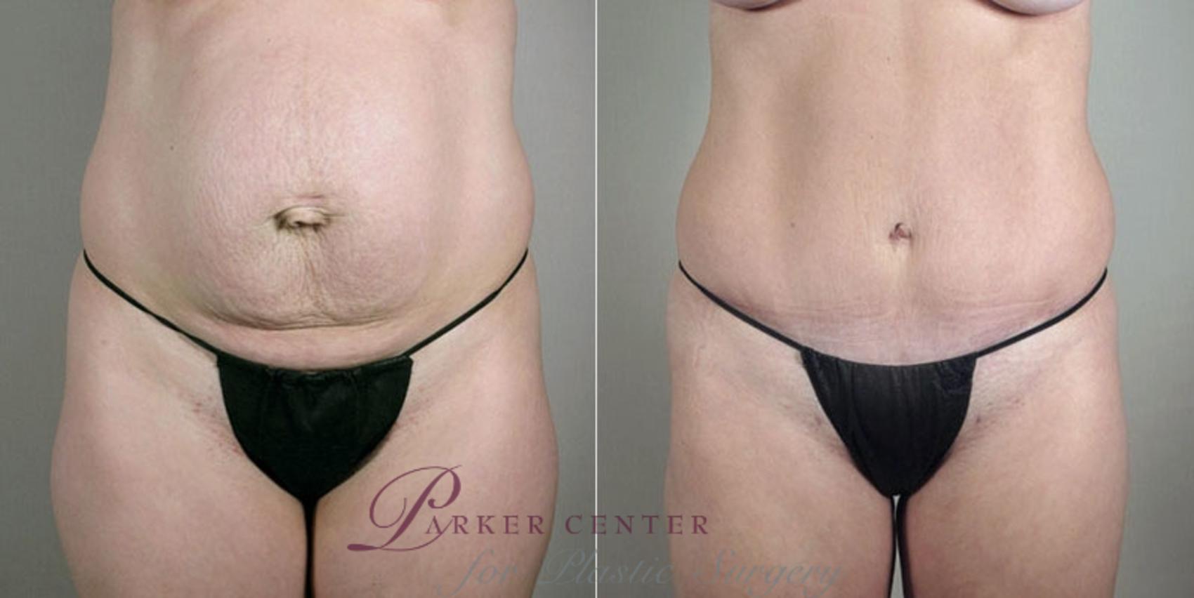 Mommy Makeover Case 1183 Before & After View  | Paramus, New Jersey | Parker Center for Plastic Surgery